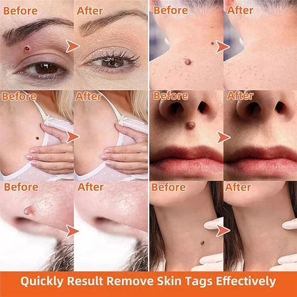 WartAway Herbal Creams Remover